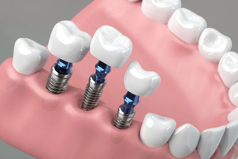 Dental Implant